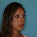 Rhinoplasty Before & After Patient #534
