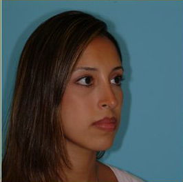 Rhinoplasty Before & After Patient #534