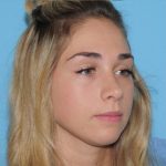 Rhinoplasty Before & After Patient #541