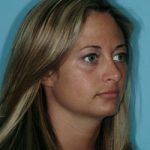 Rhinoplasty Before & After Patient #560
