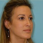 Rhinoplasty Before & After Patient #588