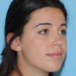 Rhinoplasty Before & After Patient #595