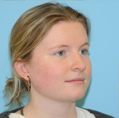 Rhinoplasty Before & After Patient #616
