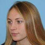 Rhinoplasty Before & After Patient #630