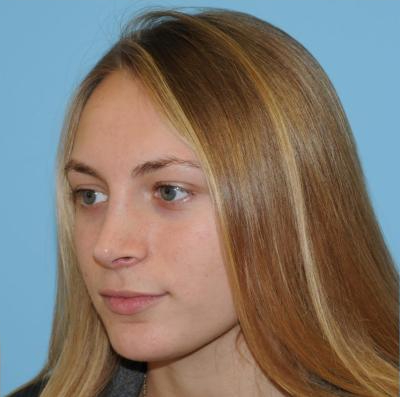 Rhinoplasty Before & After Patient #630