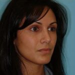 Rhinoplasty Before & After Patient #637