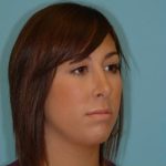 Rhinoplasty Before & After Patient #644