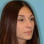 Rhinoplasty Before & After Patient #658