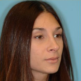 Rhinoplasty Before & After Patient #658
