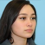 Rhinoplasty Before & After Patient #672