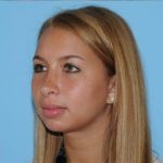 Rhinoplasty Before & After Patient #679
