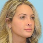 Rhinoplasty Before & After Patient #686