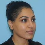 Rhinoplasty Before & After Patient #693