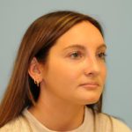 Rhinoplasty Before & After Patient #714