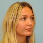 Rhinoplasty Before & After Patient #721