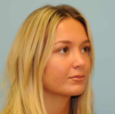 Rhinoplasty Before & After Patient #721