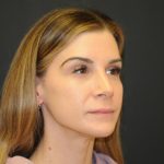 Rhinoplasty Before & After Patient #728