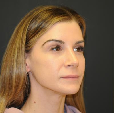 Rhinoplasty Before & After Patient #728