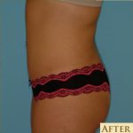 Abdominoplasty Before & After Patient #80