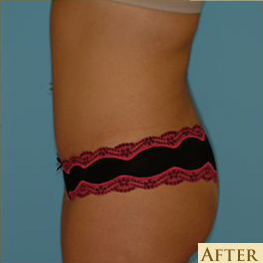 Abdominoplasty Before & After Patient #80