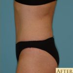 Abdominoplasty Before & After Patient #143