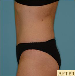 Abdominoplasty Before & After Patient #143