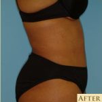 Abdominoplasty Before & After Patient #150