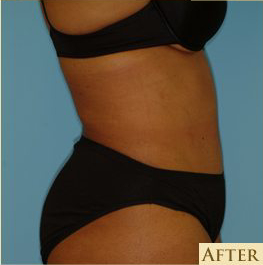 Abdominoplasty Before & After Patient #150