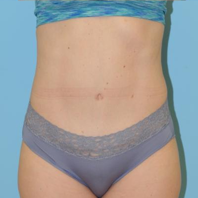 Abdominoplasty Before & After Patient #164