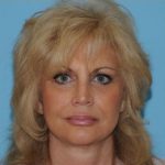 Facelift Before & After Patient #171
