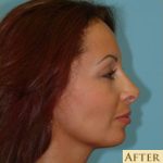 Blepharoplasty Before & After Patient #178