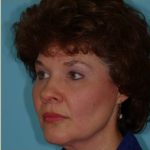 Blepharoplasty Before & After Patient #185