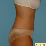Abdominoplasty Before & After Patient #73