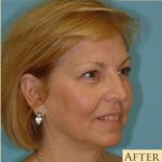 Blepharoplasty Before & After Patient #192