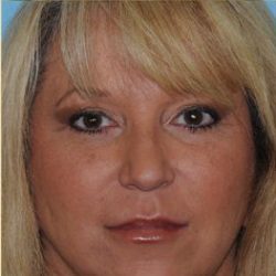 Blepharoplasty Before & After Patient #199