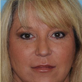 Blepharoplasty Before & After Patient #199