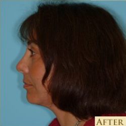 Facelift Before & After Patient #206