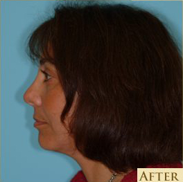 Facelift Before & After Patient #206