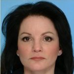 Blepharoplasty Before & After Patient #2770