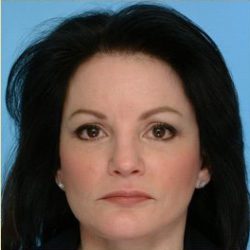 Blepharoplasty Before & After Patient #2770