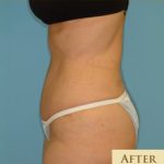 Abdominoplasty Before & After Patient #87
