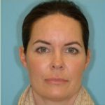 Blepharoplasty Before & After Patient #221