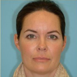 Blepharoplasty Before & After Patient #221