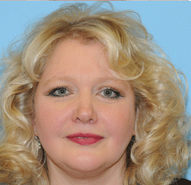 Facelift Before & After Patient #228