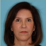 Facelift Before & After Patient #235