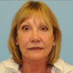 Facelift Before & After Patient #263