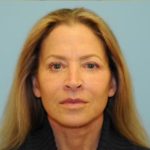 Facelift Before & After Patient #2766