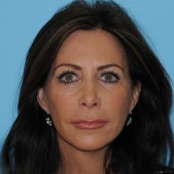 Facelift Before & After Patient #277