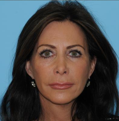 Facelift Before & After Patient #277