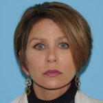 Facelift Before & After Patient #298